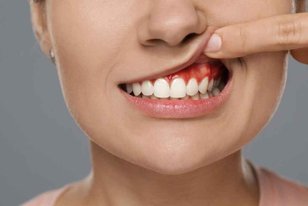 abscess treatment in mount royal calgary