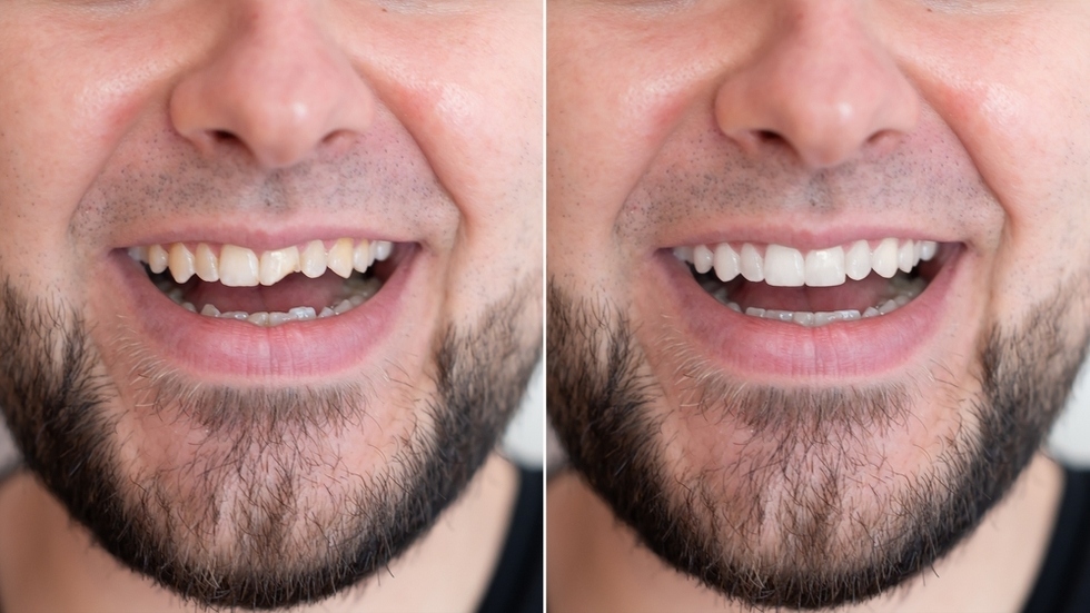 chipped teeth repair in mount royal calgary
