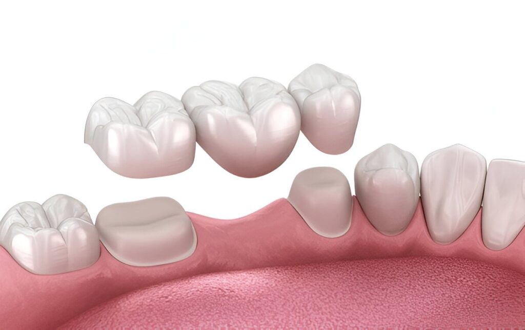 dental bridges in mount royal calgary