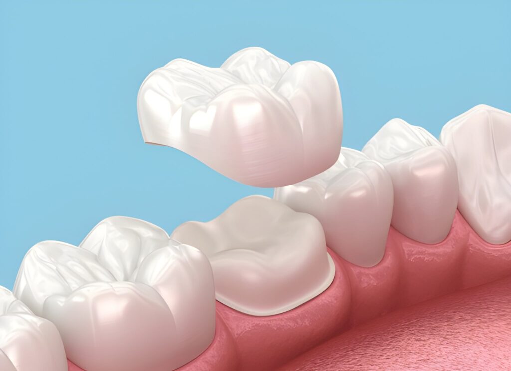 dental crowns in mount royal calgary