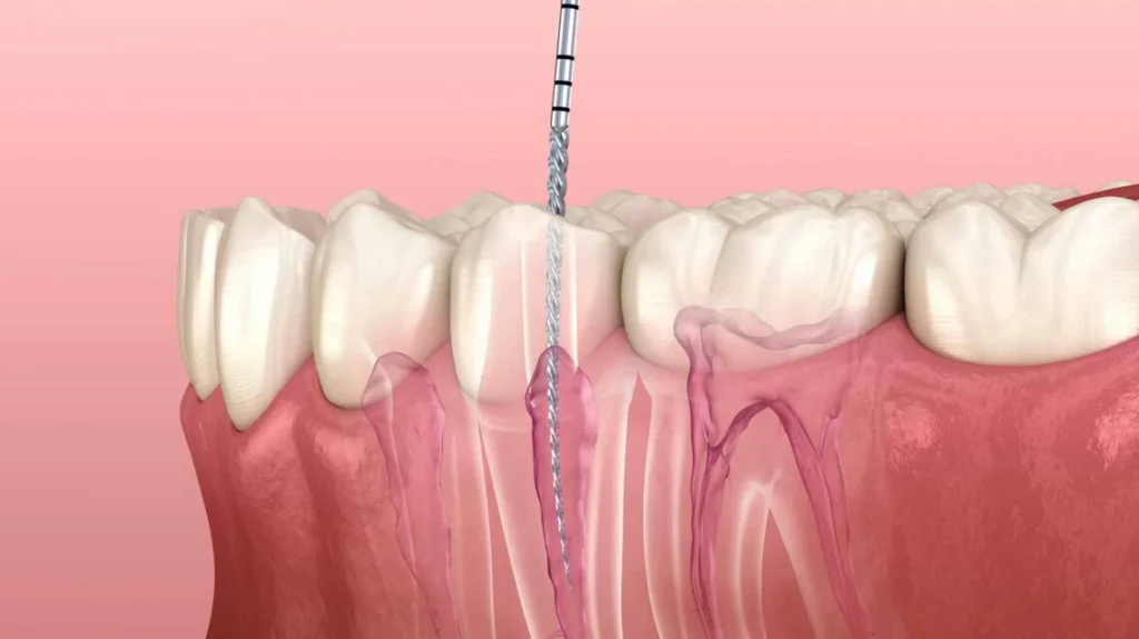emergency root canal treatment in mount royal calgary
