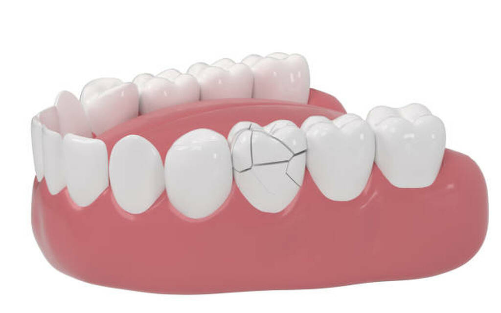 fractured teeth repair near you