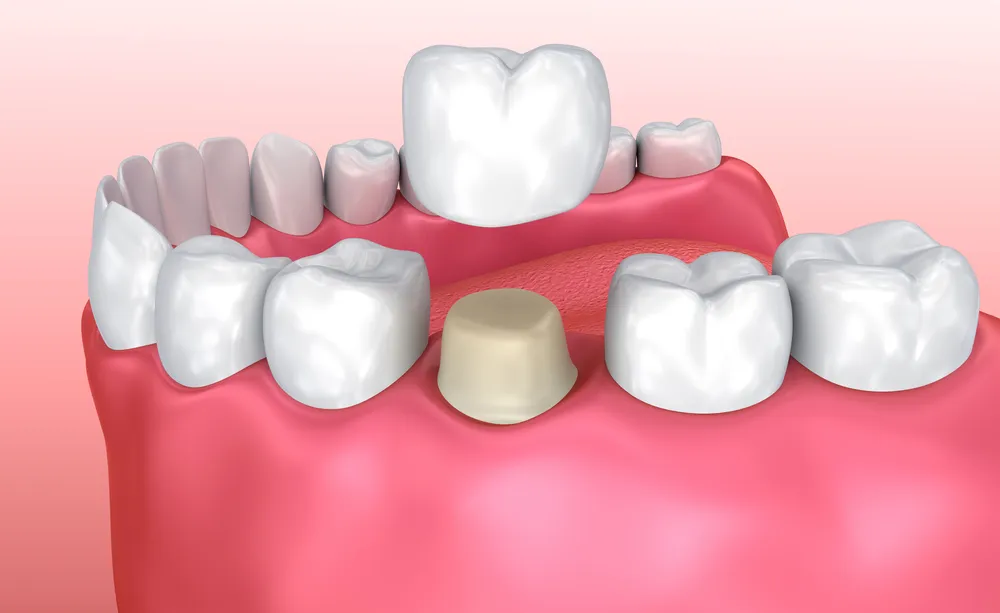 loose fillings and crowns near you