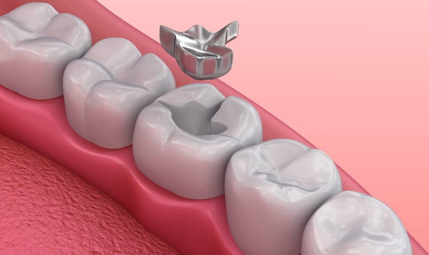 lost or loose fillings in mount royal calgary