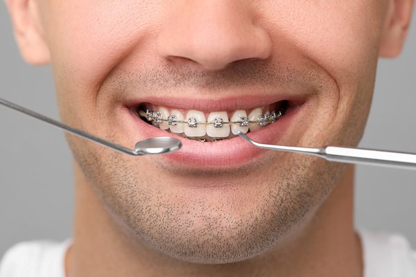 orthodontic maintenance in mount royal calgary