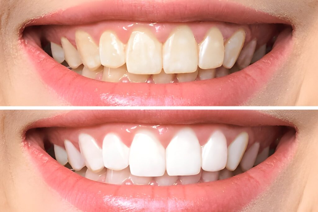 teeth whitening in mount royal calgary