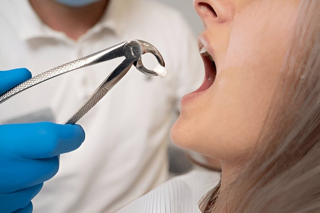 tooth extraction in mount royal calgary